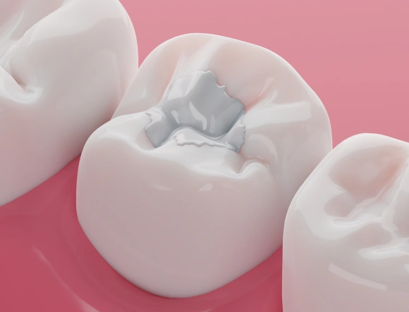 3D illustration of a tooth-colored composite filling placed in a molar