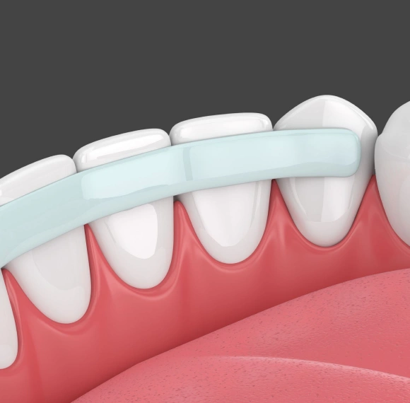 3D illustration of a dental bonding retainer wire applied to the back of the lower front teeth