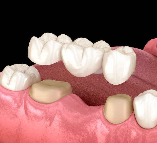 3D illustration of a dental bridge replacing missing teeth, anchored to crowns on either side