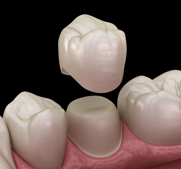 3D illustration of a dental crown being placed over a prepared tooth