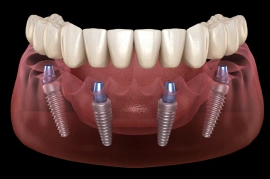 3D illustration of All-on-4 dental implants supporting a full upper arch of replacement teeth