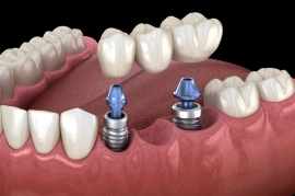 Diagram of an implant-supported dental bridge replacing two missing teeth between natural teeth