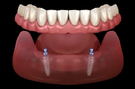 3D illustration of an implant-supported denture attaching to two dental implants in the lower jaw