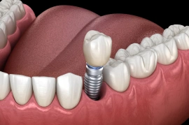 3D illustration of a single tooth dental implant with crown placed among natural teeth